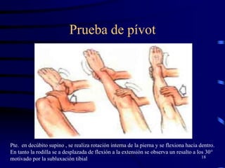 Prueba de pívot
18
Pte. en decúbito supino , se realiza rotación interna de la pierna y se flexiona hacia dentro.
En tanto la rodilla se a desplazada de flexión a la extensión se observa un resalto a los 30°
motivado por la subluxación tibial
 