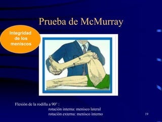 Prueba de McMurray
19
Flexión de la rodilla a 90° :
rotación interna: menisco lateral
rotación externa: menisco interno
Integridad
de los
meniscos
 