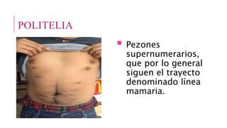POLITELIA
 Pezones
supernumerarios,
que por lo general
siguen el trayecto
denominado línea
mamaria.
 