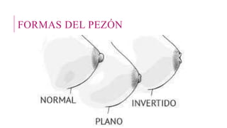 FORMAS DEL PEZÓN
 