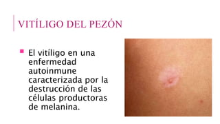VITÍLIGO DEL PEZÓN
 El vitíligo en una
enfermedad
autoinmune
caracterizada por la
destrucción de las
células productoras
de melanina.
 