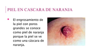 PIEL EN CASCARA DE NARANJA
 El engrosamiento de
la piel con poros
grandes se conoce
como piel de naranja
porque la piel se ve
como una cáscara de
naranja.
 