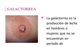 GALACTORREA
 La galactorrea es la
producción de leche
en hombres o
mujeres que no se
encuentran en
período de
 