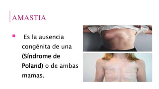 AMASTIA
 Es la ausencia
congénita de una
(Síndrome de
Poland) o de ambas
mamas.
 