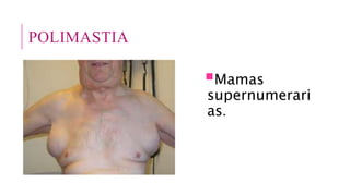 POLIMASTIA
Mamas
supernumerari
as.
 
