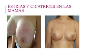 ESTRÍAS Y CICATRICES EN LAS
MAMAS
 