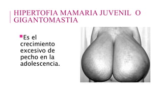 HIPERTOFIA MAMARIA JUVENIL O
GIGANTOMASTIA
Es el
crecimiento
excesivo de
pecho en la
adolescencia.
 