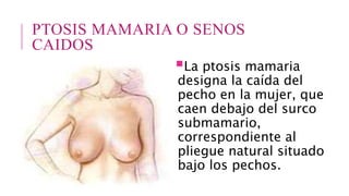 PTOSIS MAMARIA O SENOS
CAIDOS
La ptosis mamaria
designa la caída del
pecho en la mujer, que
caen debajo del surco
submamario,
correspondiente al
pliegue natural situado
bajo los pechos.
 