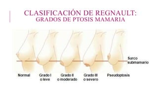 CLASIFICACIÓN DE REGNAULT:
GRADOS DE PTOSIS MAMARIA
 