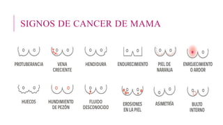 SIGNOS DE CANCER DE MAMA
 