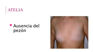 ATELIA
 Ausencia del
pezón
 