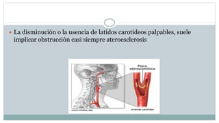  La disminución o la usencia de latidos carotideos palpables, suele
implicar obstrucción casi siempre ateroesclerosis
 