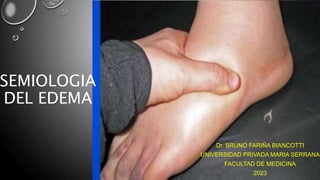 SEMIOLOGIA
DEL EDEMA
Dr. BRUNO FARIÑA BIANCOTTI
UNIVERSIDAD PRIVADA MARIA SERRANA
FACULTAD DE MEDICINA
2023
 