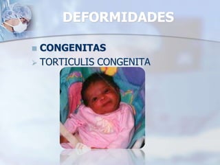 DEFORMIDADES
 CONGENITAS
 TORTICULIS CONGENITA
 