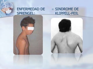  ENFERMEDAD DE
SPRENGEL:
 SINDROME DE
KLIPPELL-FEIL
 