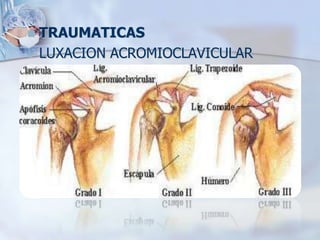  TRAUMATICAS
 LUXACION ACROMIOCLAVICULAR
 