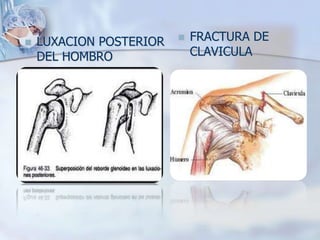  LUXACION POSTERIOR
DEL HOMBRO
 FRACTURA DE
CLAVICULA
 