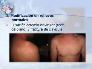 2. Modificación en relieves
normales
 Luxación acromio clavicular (tecla
de piano) y fractura de clavicula
 