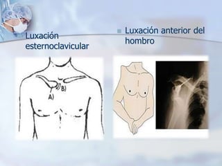  Luxación
esternoclavicular
 Luxación anterior del
hombro
 