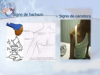  Signo de hachazo  Signo de carretera
 