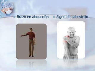  Brazo en abducción  Signo de cabestrillo
 