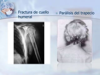  Fractura de cuello
humeral
 Parálisis del trapecio
 