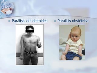  Parálisis del deltoides  Parálisis obstétrica
 