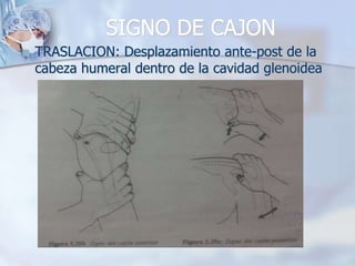 SIGNO DE CAJON
 TRASLACION: Desplazamiento ante-post de la
cabeza humeral dentro de la cavidad glenoidea
 