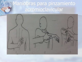 Maniobras para pinzamiento
acromioclavicular
 