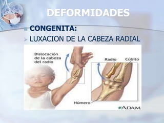 DEFORMIDADES
 CONGENITA:
 LUXACION DE LA CABEZA RADIAL
 