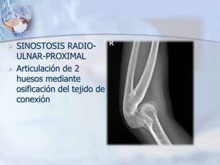  SINOSTOSIS RADIO-
ULNAR-PROXIMAL
 Articulación de 2
huesos mediante
osificación del tejido de
conexión
 