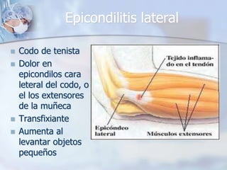 Epicondilitis lateral
 Codo de tenista
 Dolor en
epicondilos cara
leteral del codo, o
el los extensores
de la muñeca
 Transfixiante
 Aumenta al
levantar objetos
pequeños
 