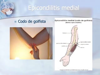 Epicondilitis medial
 Codo de golfista
 