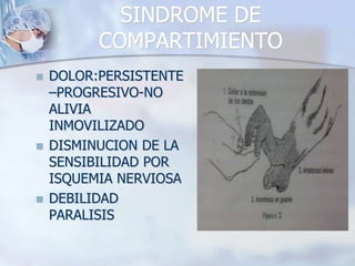 SINDROME DE
COMPARTIMIENTO
 DOLOR:PERSISTENTE
–PROGRESIVO-NO
ALIVIA
INMOVILIZADO
 DISMINUCION DE LA
SENSIBILIDAD POR
ISQUEMIA NERVIOSA
 DEBILIDAD
PARALISIS
 