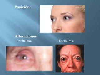 Posición:




Alteraciones:
 Enoftalmia     Exoftalmia
 