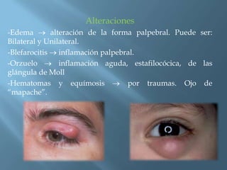 Alteraciones
-Edema       alteración de la forma palpebral. Puede ser:
Bilateral y Unilateral.
-Blefarocitis inflamación palpebral.
-Orzuelo        inflamación aguda, estafilocócica, de las
glángula de Moll
-Hematomas y equímosis            por traumas. Ojo de
“mapache”.
 