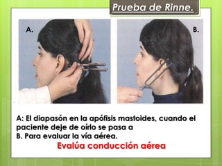 Prueba de Rinne.
A.

B.

A: El diapasón en la apófisis mastoides, cuando el
paciente deje de oírlo se pasa a
B. Para evaluar la vía aérea.

Evalúa conducción aérea

 