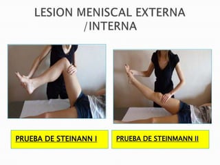 PRUEBA DE STEINANN I   PRUEBA DE STEINMANN II
 