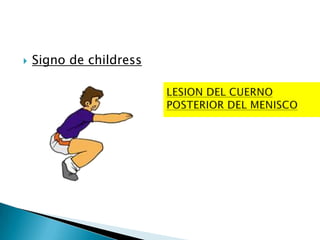    Signo de childress
 