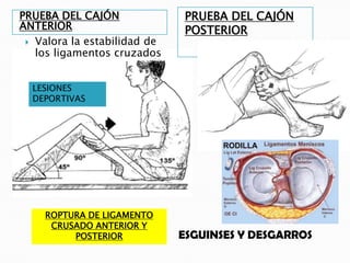 PRUEBA DEL CAJÓN              PRUEBA DEL CAJÓN
ANTERIOR                      POSTERIOR
  Valora la estabilidad de
   los ligamentos cruzados


  LESIONES
  DEPORTIVAS




    ROPTURA DE LIGAMENTO
     CRUSADO ANTERIOR Y
         POSTERIOR            ESGUINSES Y DESGARROS
 