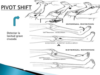 Detectar la
laxitud grave
cruzada
 