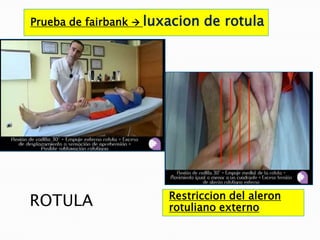 Prueba de fairbank  luxacion   de rotula




                       Restriccion del aleron
ROTULA                 rotuliano externo
 