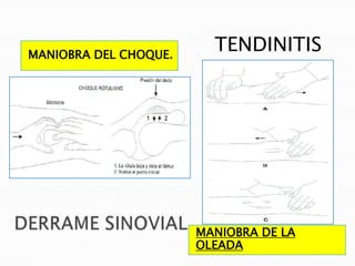 MANIOBRA DEL CHOQUE.
                         TENDINITIS




                       MANIOBRA DE LA
                       OLEADA
 