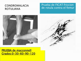 Prueba de FICAT:friccion
                        de rotula contra el femur




PRUEBA de macconnell
Grados:0-30-60-90-120
 