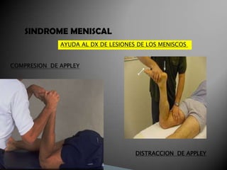 SINDROME MENISCAL
      AYUDA AL DX DE LESIONES DE LOS MENISCOS




                             DISTRACCION DE APPLEY
 