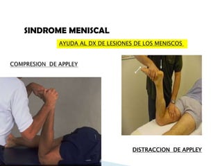 SINDROME MENISCAL
      AYUDA AL DX DE LESIONES DE LOS MENISCOS




                             DISTRACCION DE APPLEY
 
