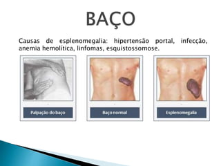 Causas de esplenomegalia: hipertensão portal, infecção,
anemia hemolítica, linfomas, esquistossomose.
 