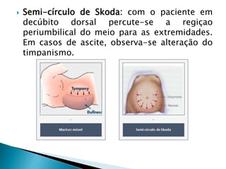  Semi-círculo de Skoda: com o paciente em
decúbito dorsal percute-se a regiçao
periumbilical do meio para as extremidades.
Em casos de ascite, observa-se alteração do
timpanismo.
 