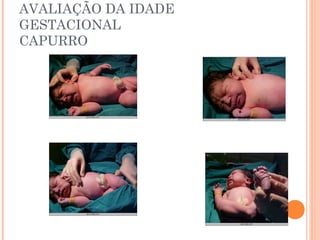 AVALIAÇÃO DA IDADE
GESTACIONAL
CAPURRO
 