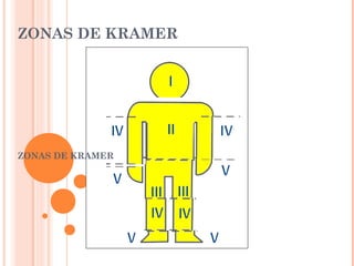 ZONAS DE KRAMER
ZONAS DE KRAMER
 